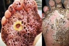 Trypophobic Foot