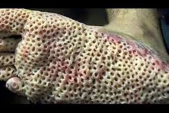 Trypophobia Causing Foot