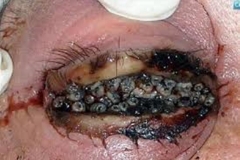 Trypophobic Eye
