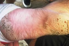 Trypophobia Rash