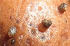 Trypophobic Skin Tags