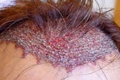 Trypophobic Head Rash
