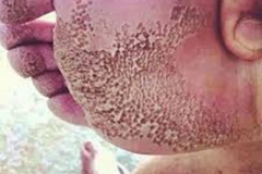 Trypophobic Foot Rash