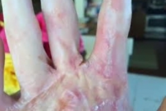Trypophobic Warts