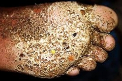 Diseased Trypophobic Foot
