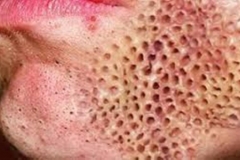 Trypophobic Face