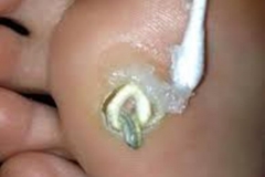 Trypophobic Infested Foot