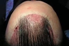 Scaly Trypophobic Rash
