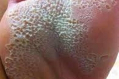 Trypophobic Rash
