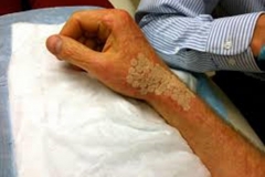 Trypophobic Skin Disease