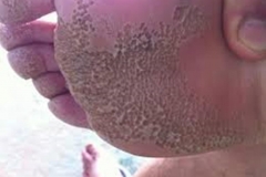 Trypophobic Holes in Foot
