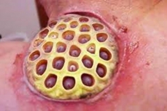 Trypophobic Hand Wound