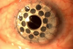 Trypophobic Eyeball