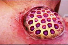 Trypophobic Lotus Pod Growth
