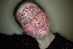 Trypophobic Acne