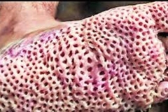 Trypophobic Foot
