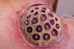 Trypophobic Wound
