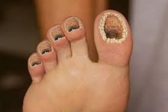 Trypophobic Toes