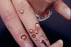 Trypophobic Lotus Pod Fingers