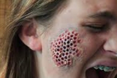 Trypophobic Face Rash