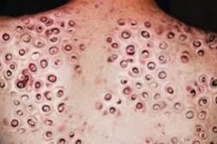 Trypophobic Back Rash