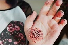 Trypophobia Causing Hand