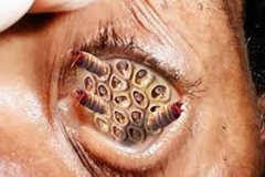 Eye of Trypophobia