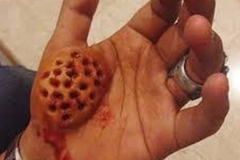 Oozing Trypophobic Palm
