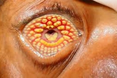 Trypophobic Eye