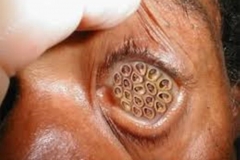Trypophobic Eyeball
