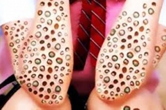 Trypophobic Forearms