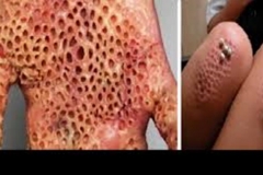 Trypophobic Palm 5