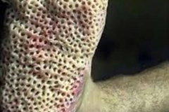 Trypophobia Foot