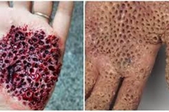 Bloody Trypophobic Wound