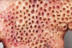 Trypophobic Palm 6