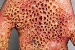 Trypophobic Palm 3
