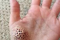 Trypophobia Boil