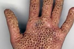 Trypophobic Palm 4