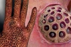 Trypophobic Lotus Pod Wound