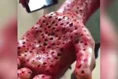 Trypophobic Palm 7