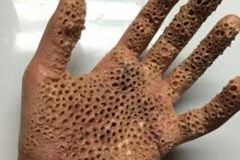 Trypophobic Palm 8