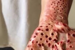 Trypophobic Skin