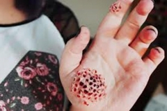 Trypophobic Finger