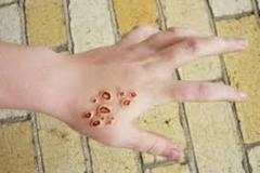 Trypophobia Hand