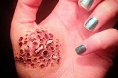 Trypophobic Hand Wound