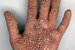 Trypophobic Palm 9