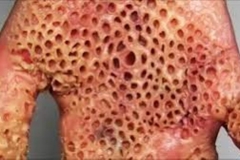 Trypophobic Palm 10